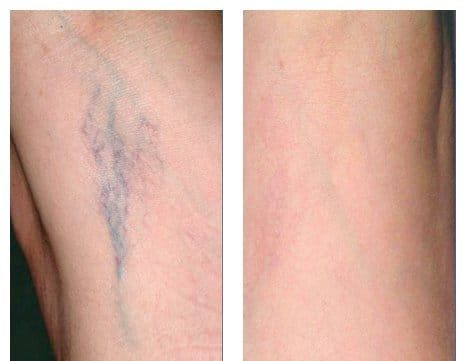 Spider Veins Spoiled Laser