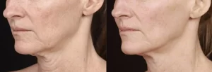 skin-tightening