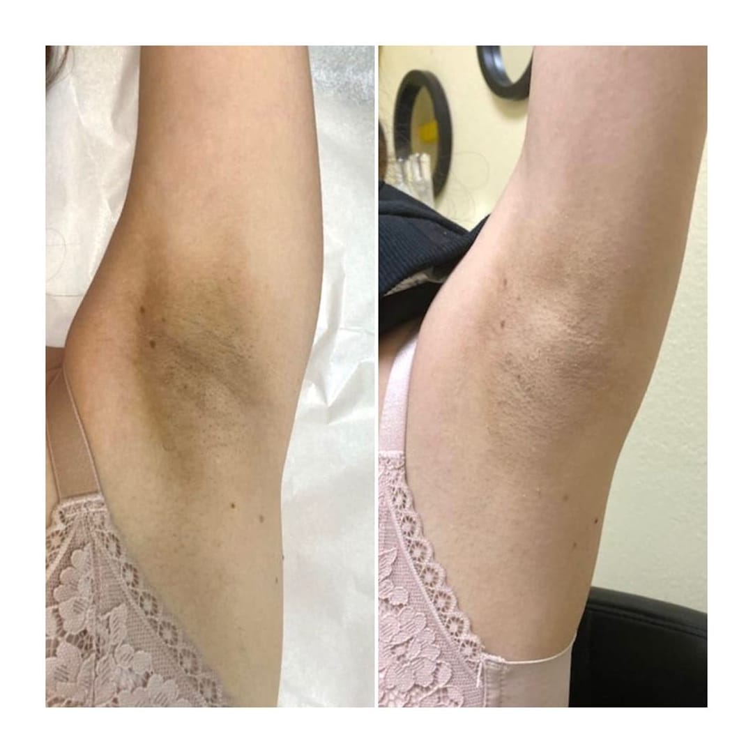 Private Areas Intimate Bleaching Before And After Spoiled Laser