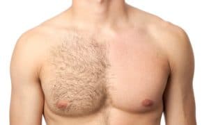 Men’s Laser Hair Removal