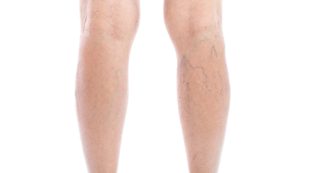 Spider Vein Removal Spoiled Laser