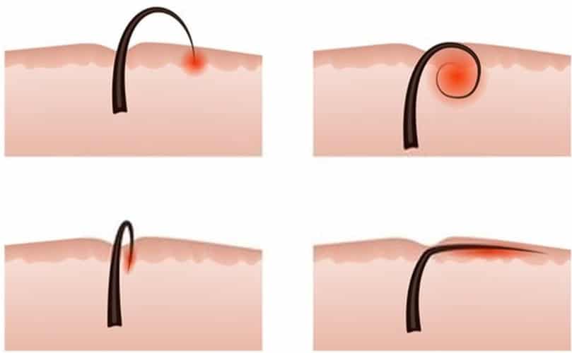 Laser Hair Removal Timeline