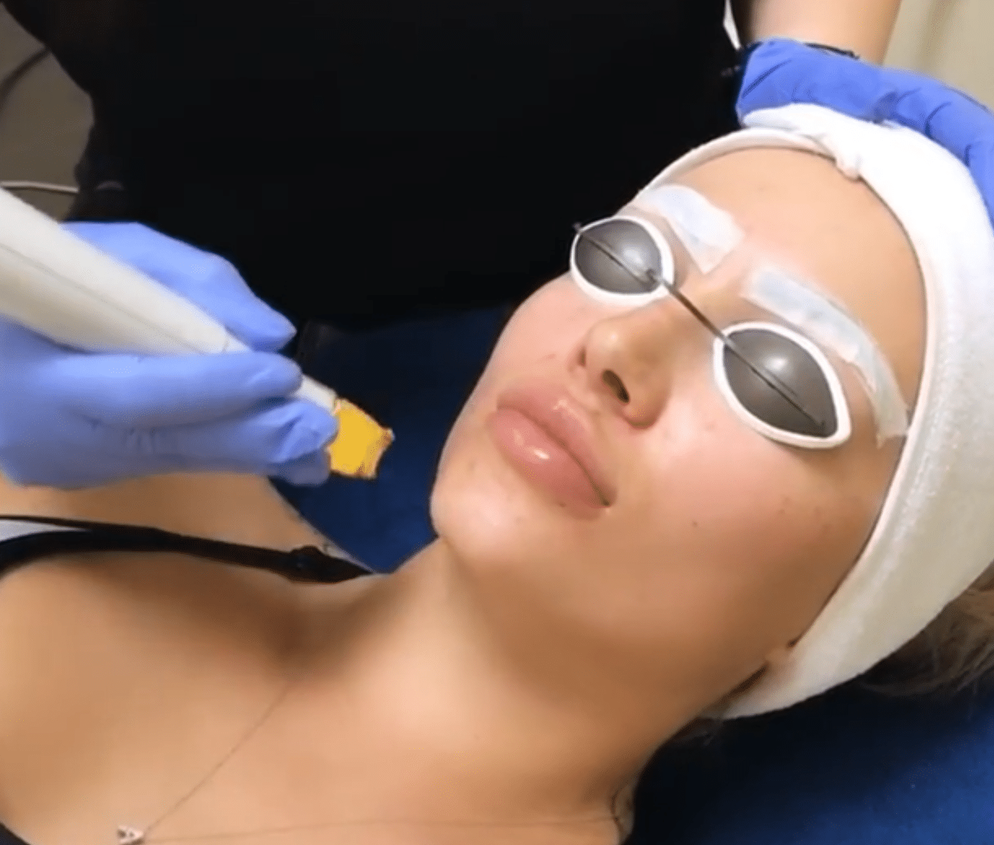 Las Vegas Laser Hair Removal Services