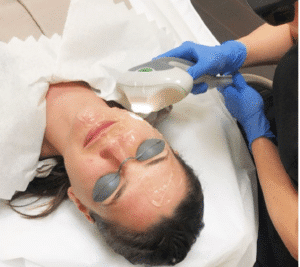 Types of Laser Treatments 3