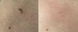 Skin Tags Removal Las Vegas