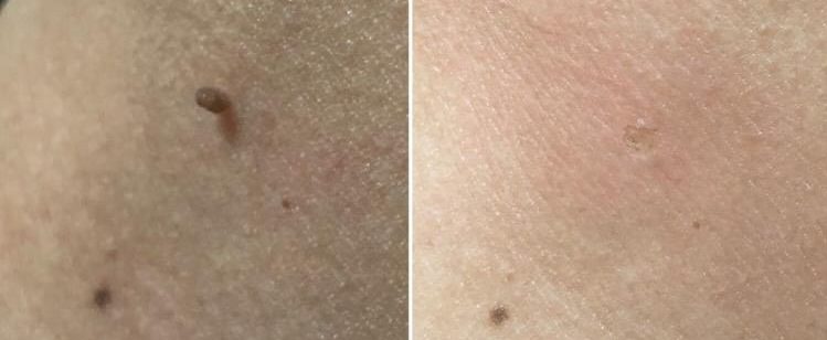 Top Surgical Skin Tags Removal That Is Effective For Suffers