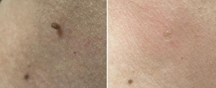 Skin Tags Removal Las Vegas