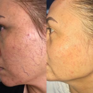Spoiled Laser Spider Veins Removal