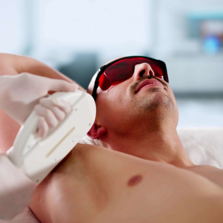 Man receiving underarm laser hair removal
