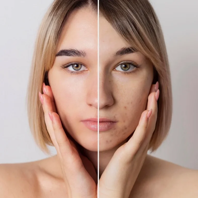 Acne reduction results from medical spa treatments