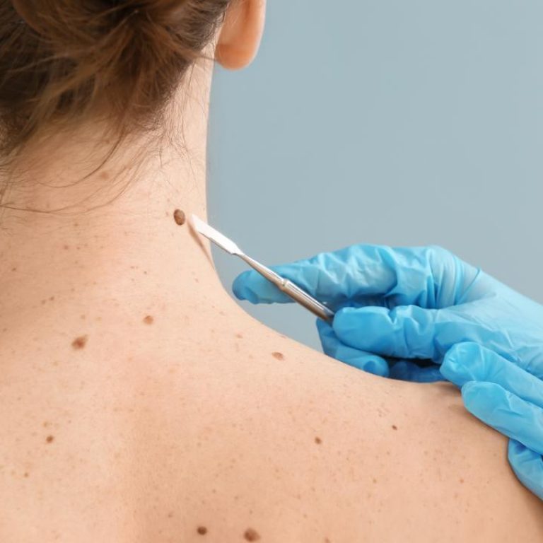 Professional skin tag removal at Spoiled Aesthetics